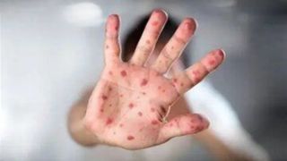 هشدار سازمان جهانی بهداشت؛ شیوع جهانی سرخک با سرعت هشدار سازمان جهانی بهداشت؛ شیوع جهانی سرخک با سرعت