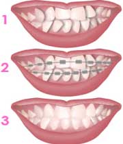 چگونگی درمان دندان ها به وسیله ارتودنسی