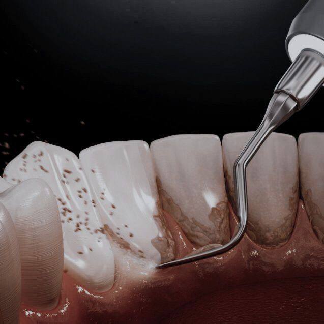مراحل ایمپلنت دندان 