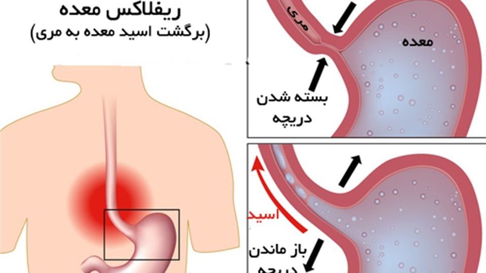 علائم و نشانههای رفلاکس معده علائم و نشانههای رفلاکس معده