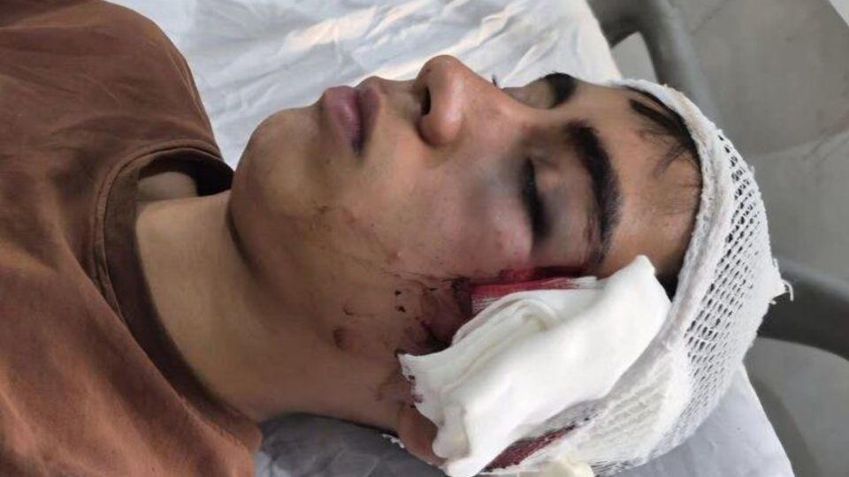 مصدومیت شدید دانشآموز توسط معلم در دهبکری بم مصدومیت شدید دانشآموز توسط معلم در دهبکری بم