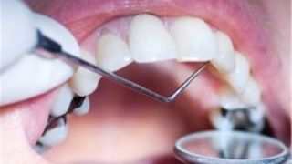 چگونه از ریشه دندان‌ها در برابر آفات محافظت کنیم؟