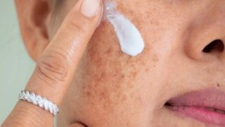 لکههای پوستی بارداری؛ چرا و چگونه پیشگیری کنیم؟ لکههای پوستی بارداری؛ چرا و چگونه پیشگیری کنیم؟