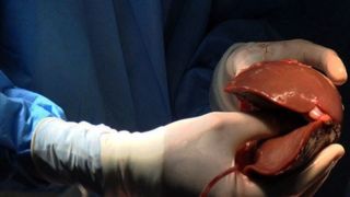 این خوراکیها کبدتان را چرب میکند/ کبد چرب جای هپاتیت B را در فهرست انتظار پیوند گرفت این خوراکیها کبدتان را چرب میکند/ کبد چرب جای هپاتیت B را در فهرست انتظار پیوند گرفت