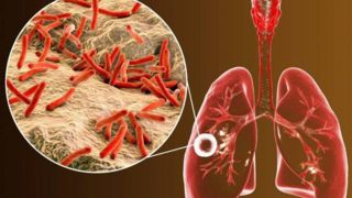 شناسایی ۶۵۶۵ مبتلا به "سل" در کشور/ تشخیص و درمان بیماری در مراکز بهداشتی رایگان است شناسایی ۶۵۶۵ مبتلا به "سل" در کشور/ تشخیص و درمان بیماری در مراکز بهداشتی رایگان است